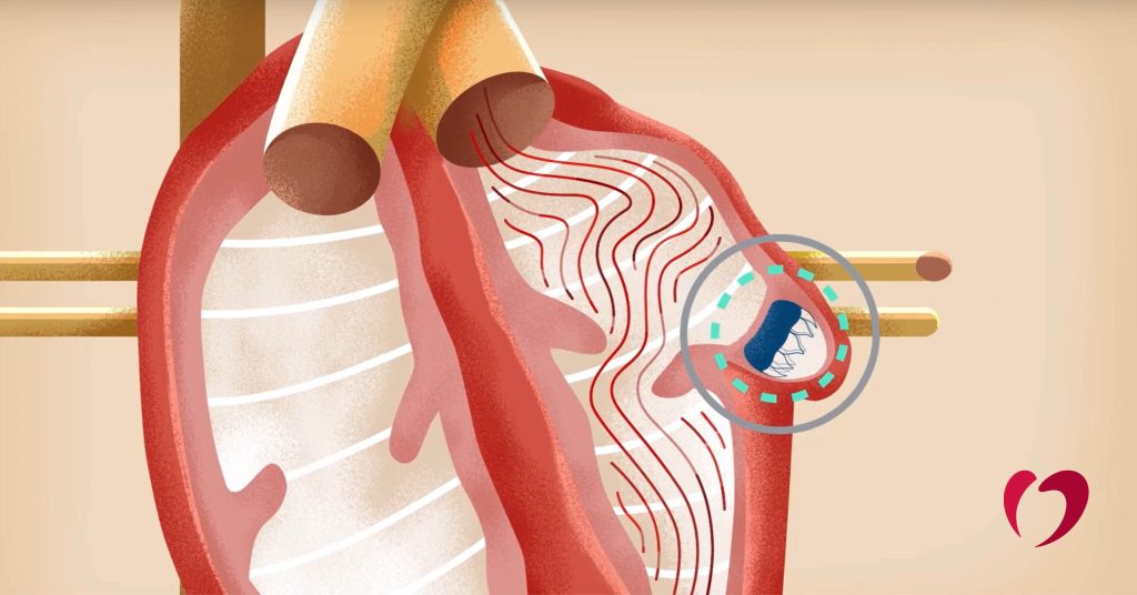 Overview of the Watchman Procedure